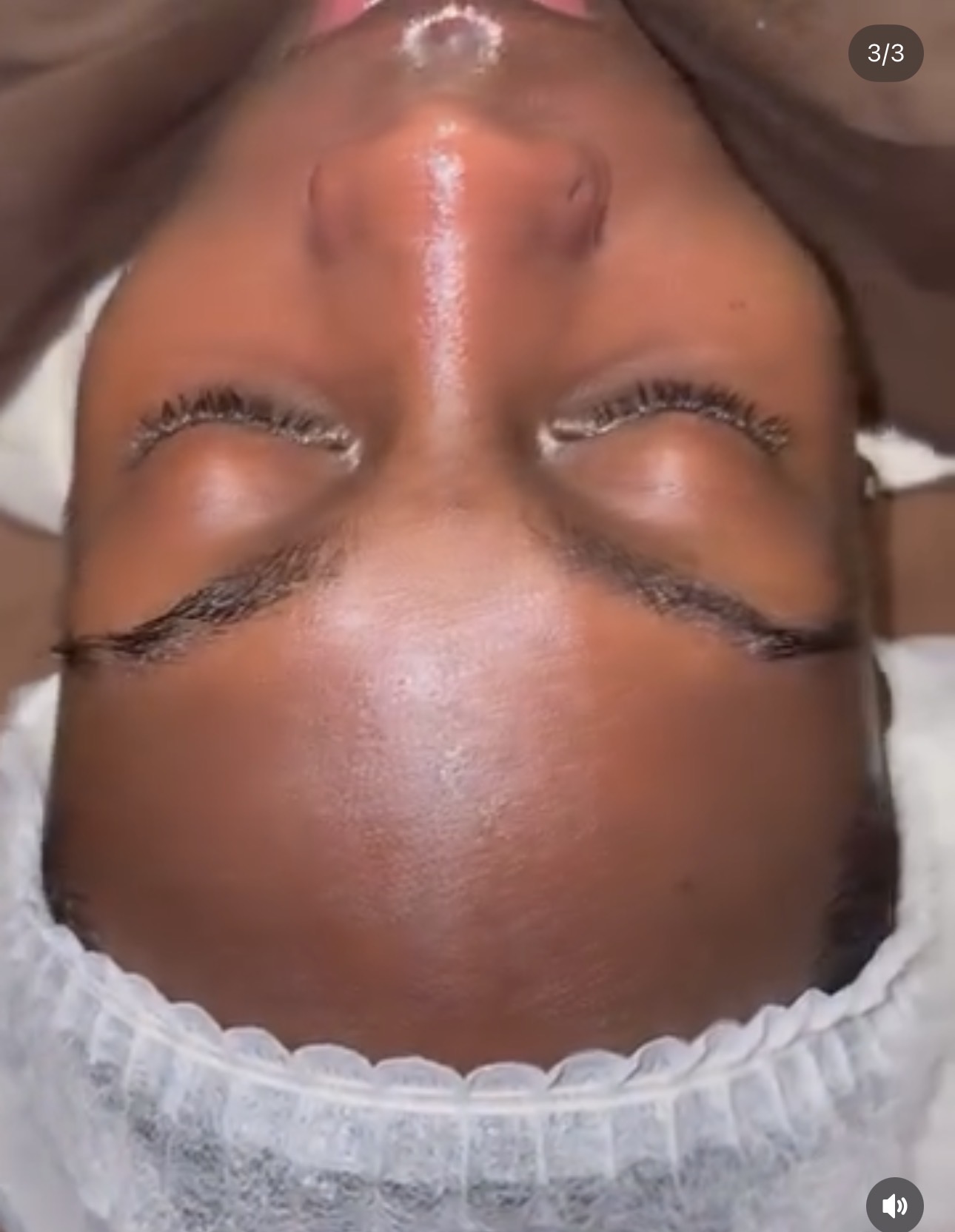 Guest skin after a dehydrated skin rebalancing facial